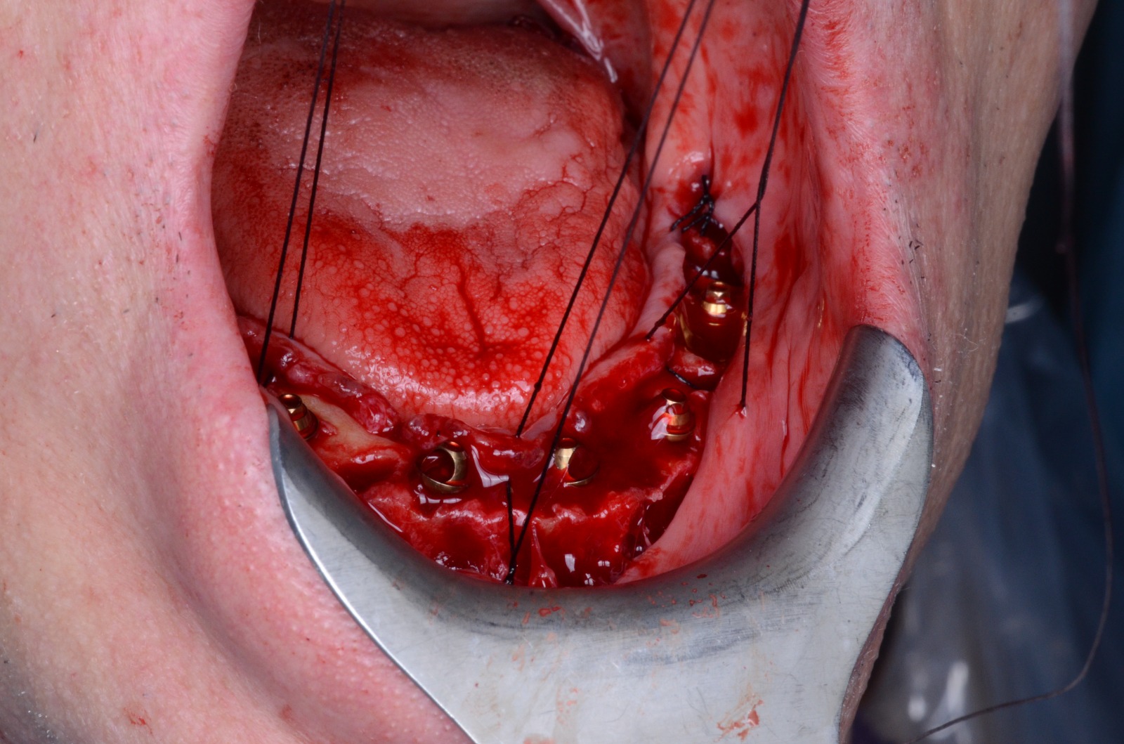 Intraoperative view of shoelace sutures placed but not yet tied across the ridge, retracted, while the provisional prints