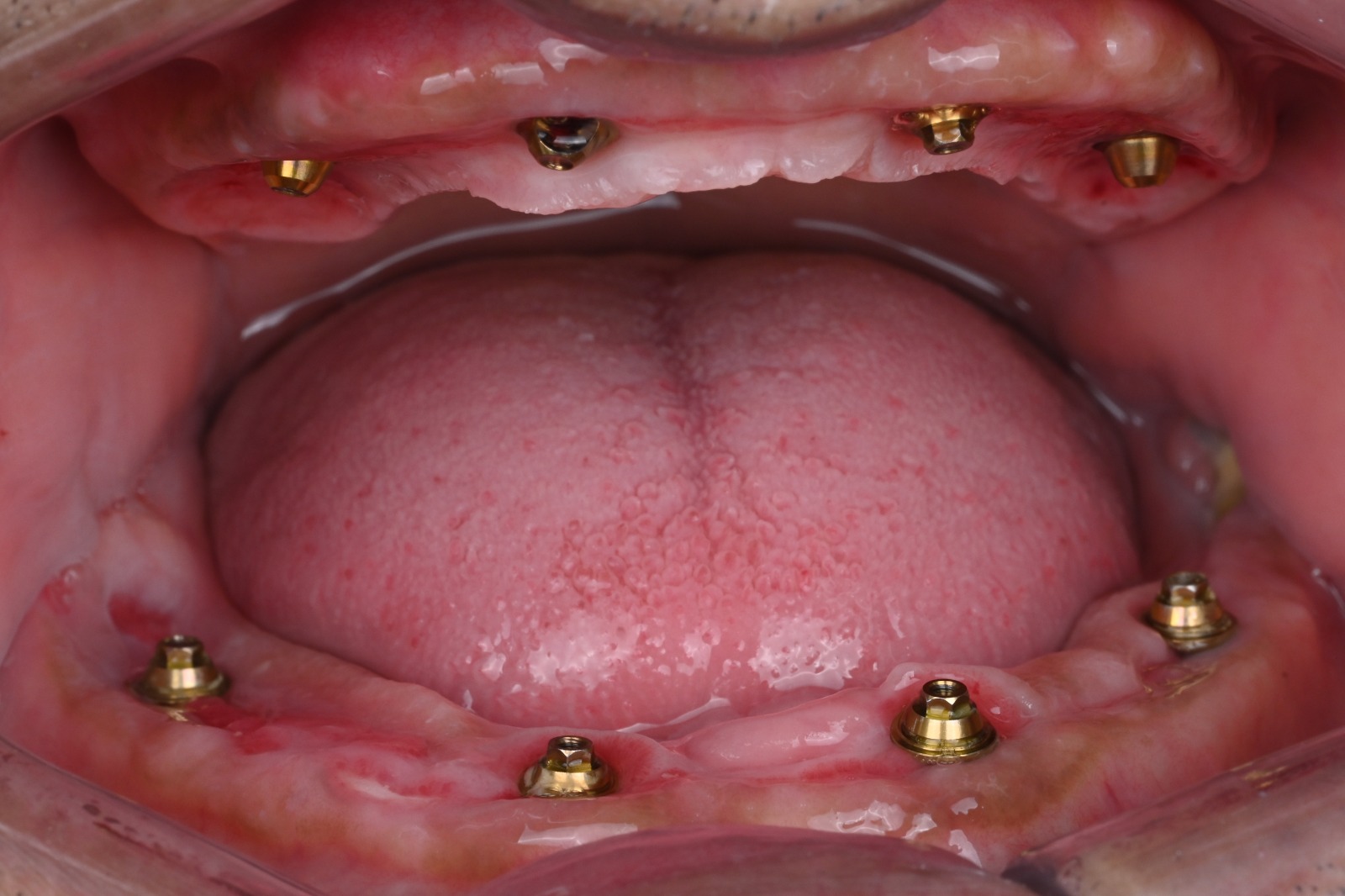 Full-mouth view showing healed tissue around abutments on both the upper and lower arches at 2.5 weeks post-surgery