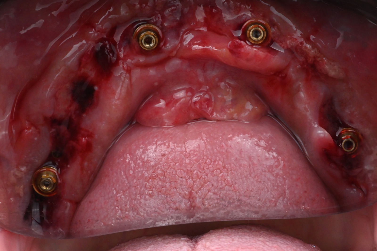 Close-up occlusal view of the healed lower ridge at 2.5 weeks post-surgery