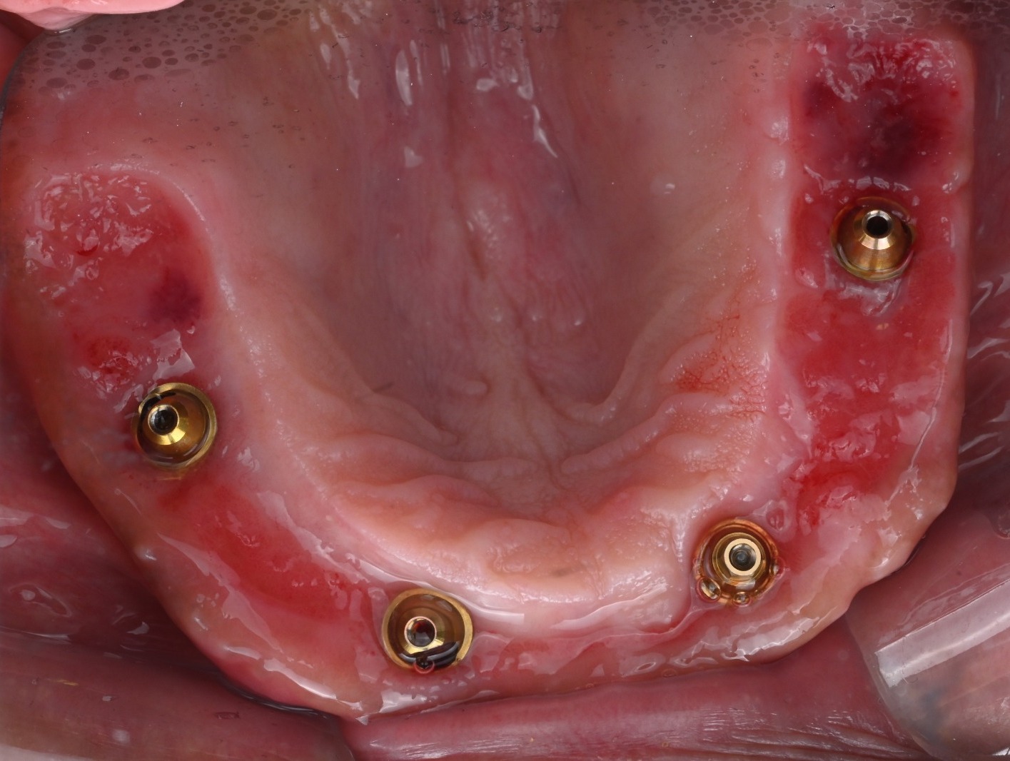 Occlusal view of the healed upper ridge at 2.5 weeks post-surgery, showing keratinized tissue closely adapted around four abutments