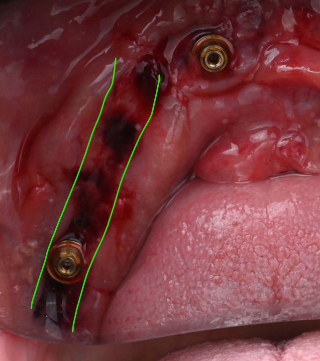 Buccal view of two implant sites with the intended prosthetically-guided tissue space outlined along the ridge between them